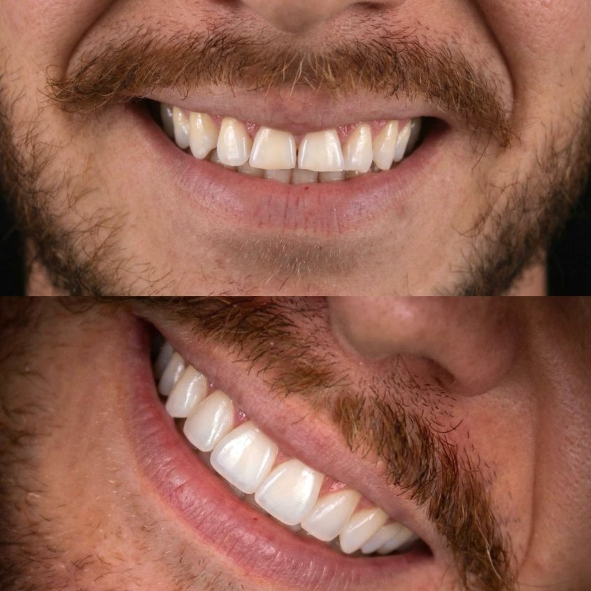 Antes e depois — lentes de porcelana