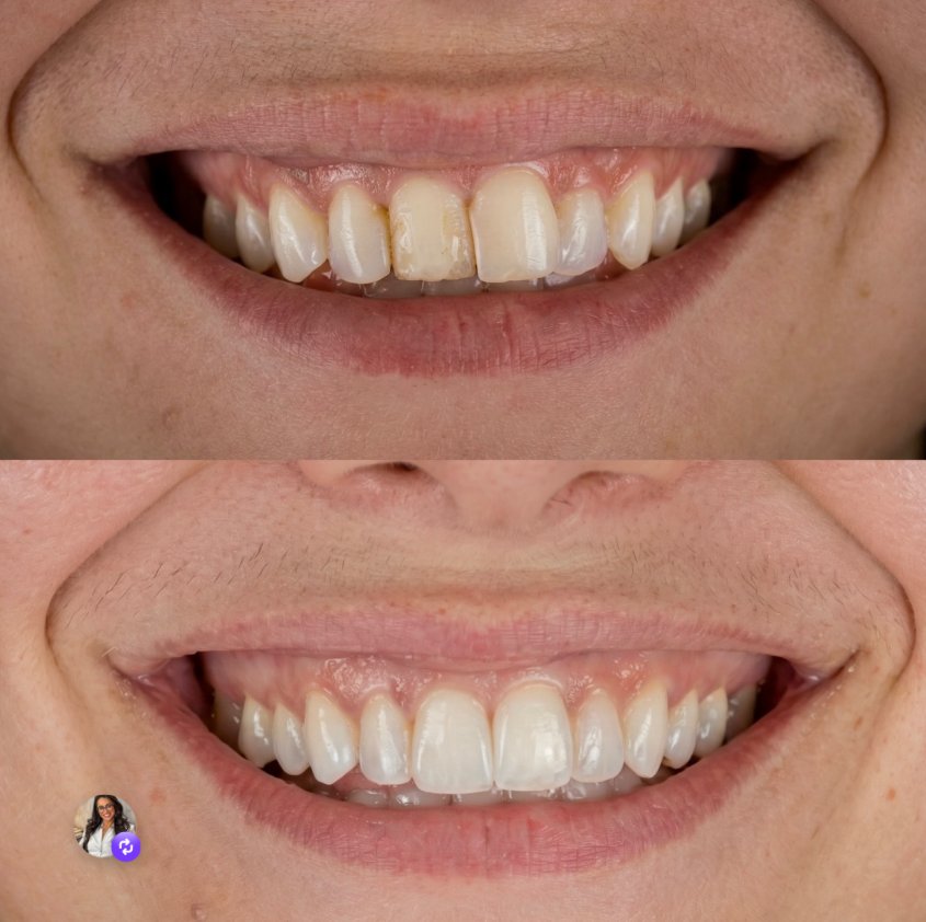 Antes e depois — facetas em resina