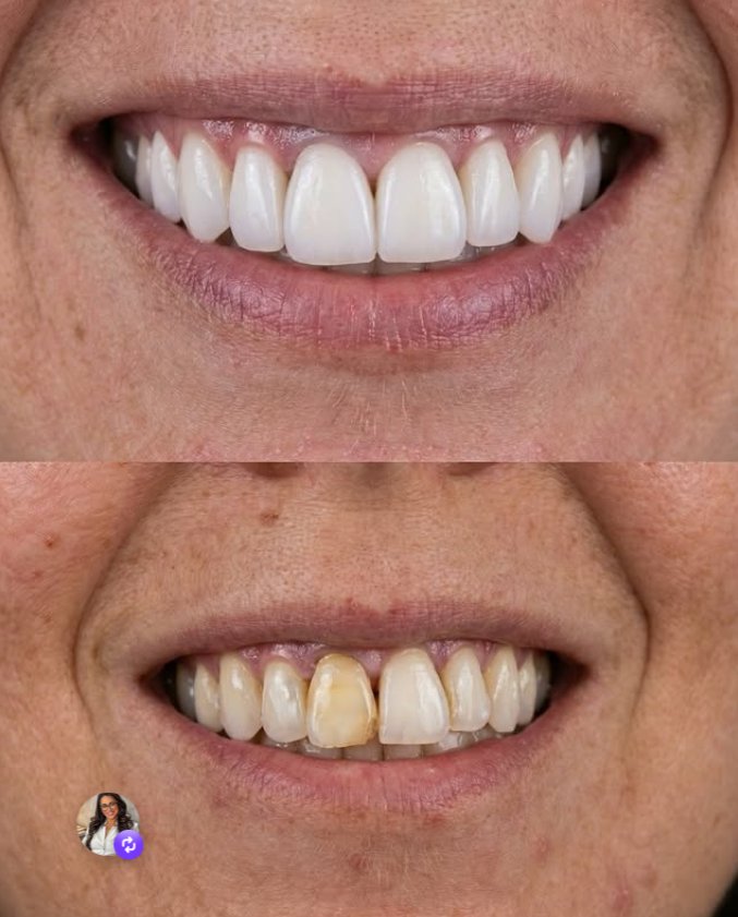 Antes e depois — harmonização do sorriso